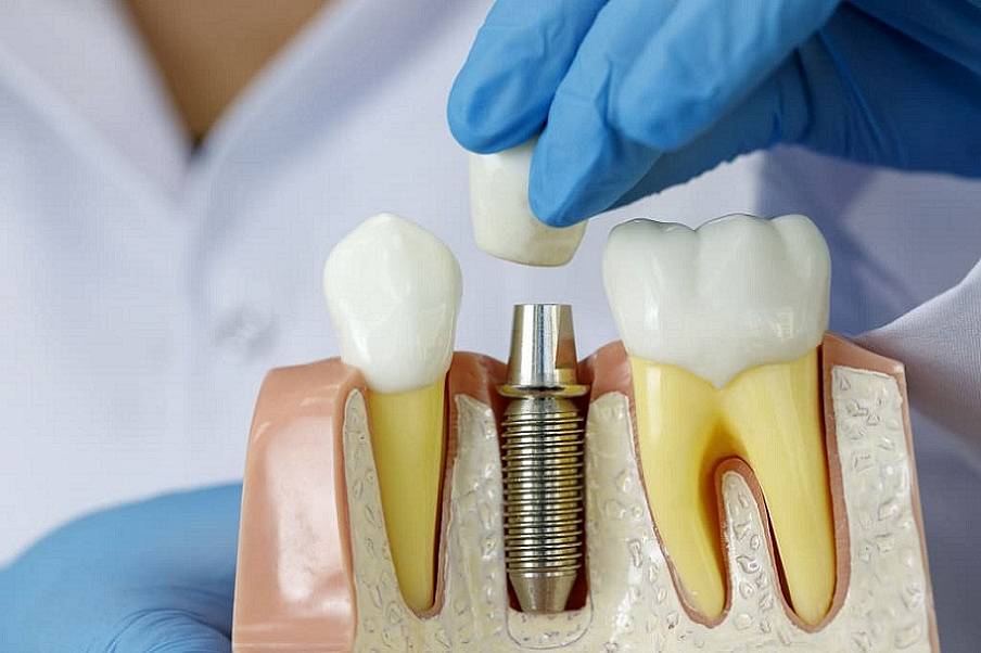 Что такое зубные импланты (имплантаты)?